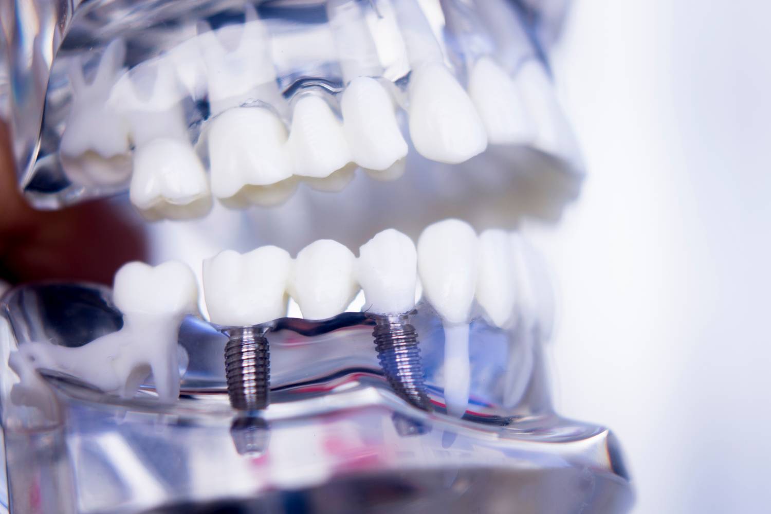 Implanty dentystyczne — często zadawane pytania