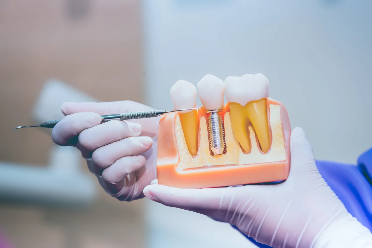 Kiedy po wyrwaniu zęba można wstawić implant?
