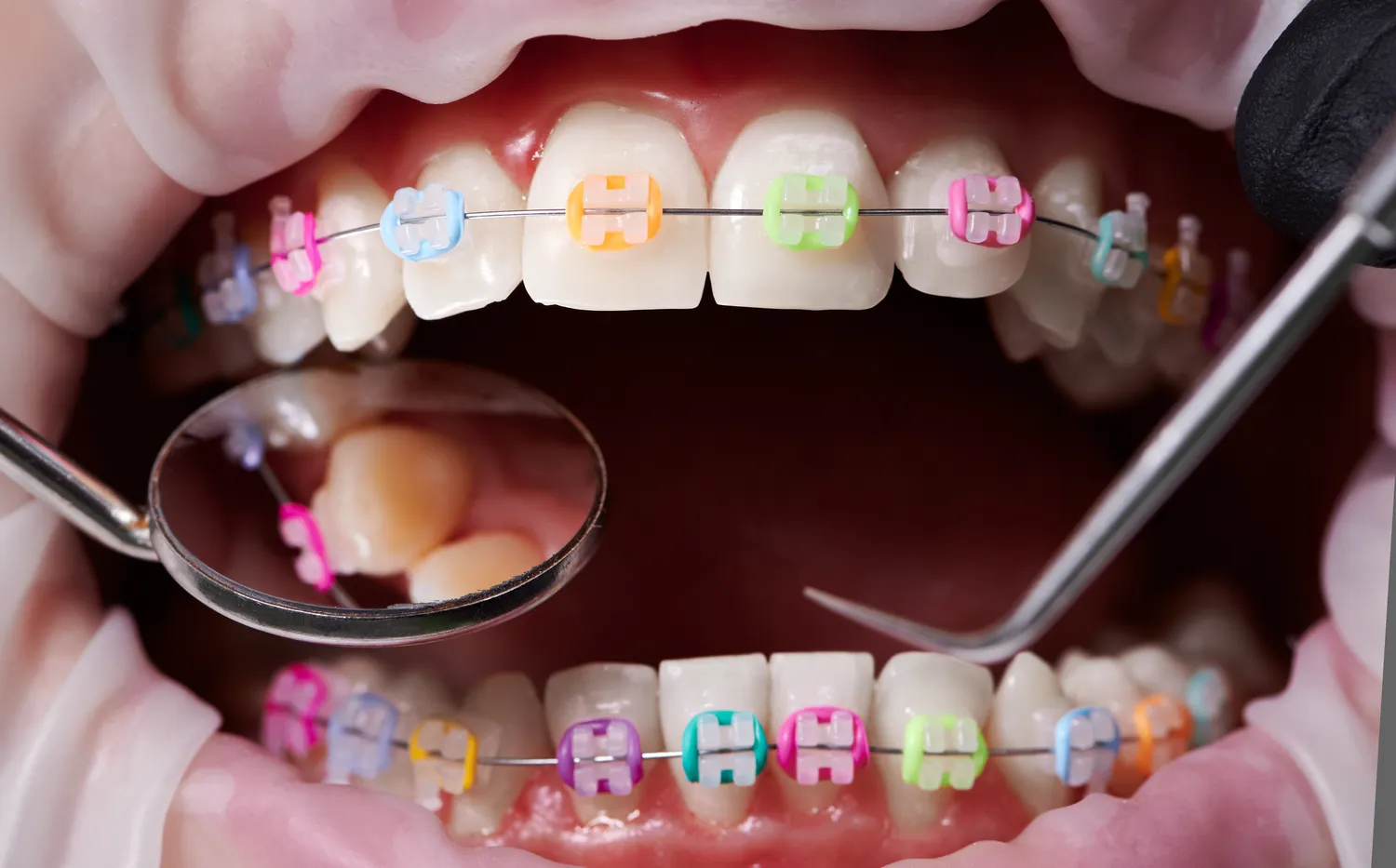Implanty dentystyczne – czy mogą zastąpić prawdziwe zęby?