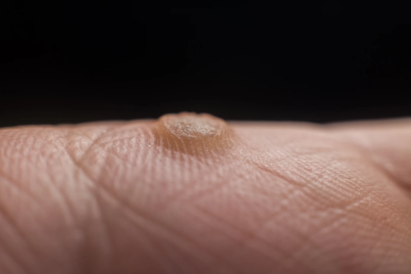 Co jest najlepsze na kurzajki?