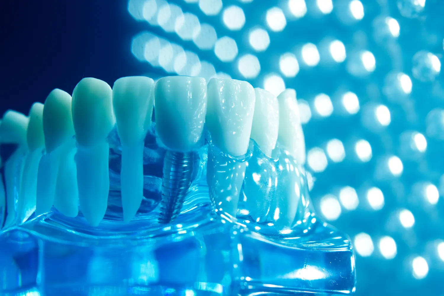 Implanty w jeden dzień Kołobrzeg